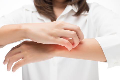 Bug Bite